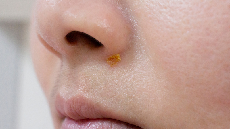 Illustration related to impetigo