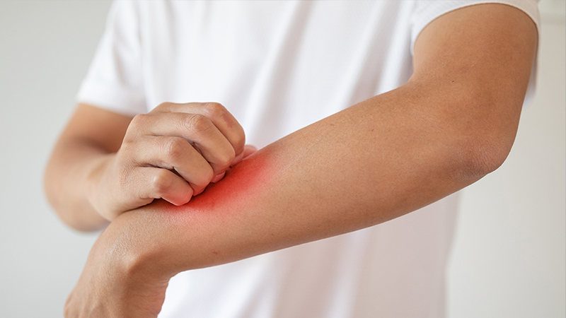 Illustration related to an insect bite